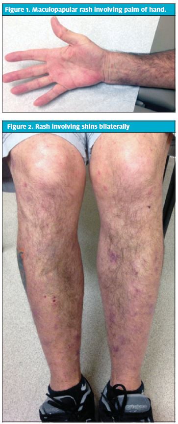 Syphilis Leg Pain