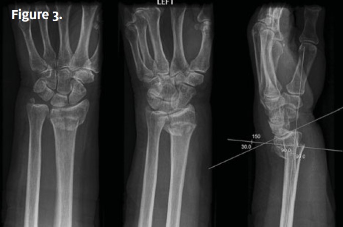 Wrist Pain In An Adult After A Fall Page 2 Of 2 Journal Of Urgent   Case0516 3 