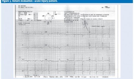 Acute MI After a Normal Stress Test