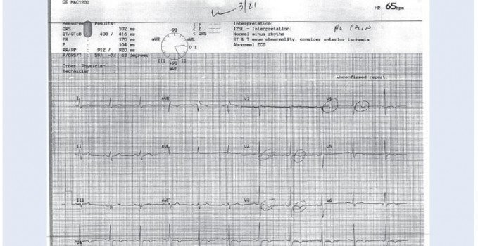 Acute MI After a Normal Stress Test