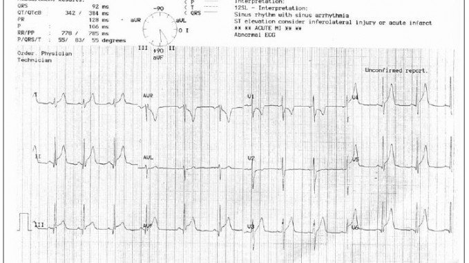 Acute Rheumatic Fever ECG