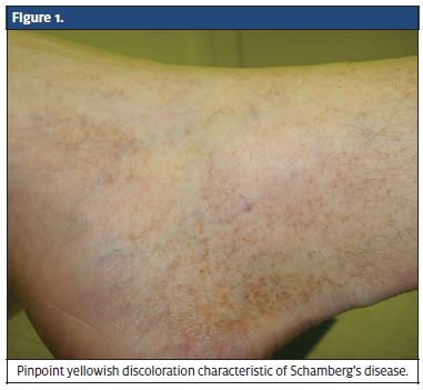 Schamberg’s Disease - Journal of Urgent Care Medicine