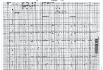 Rheumatic Fever