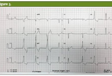 cholecystitis