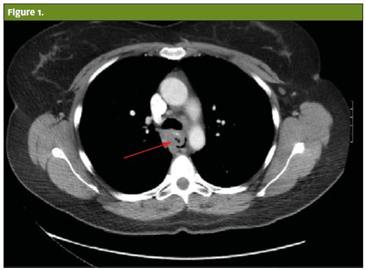 abnormal esophagram boerhaave