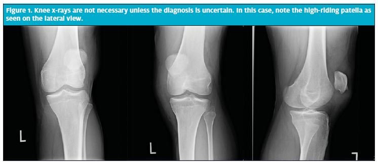 Acute Severe Thigh Pain While Running