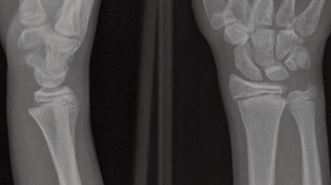 Salter I Fracture of the Distal Radius and Distal Ulnar Styloid X-ray 1