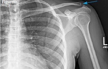 Clavicular Pain X-ray Resolution