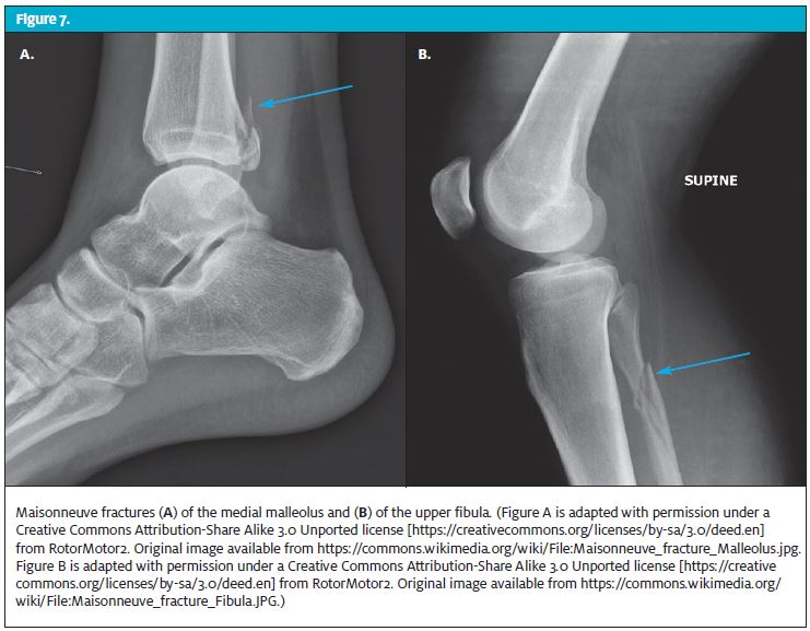 Ankle Fractures (Medial) - Upswing Health