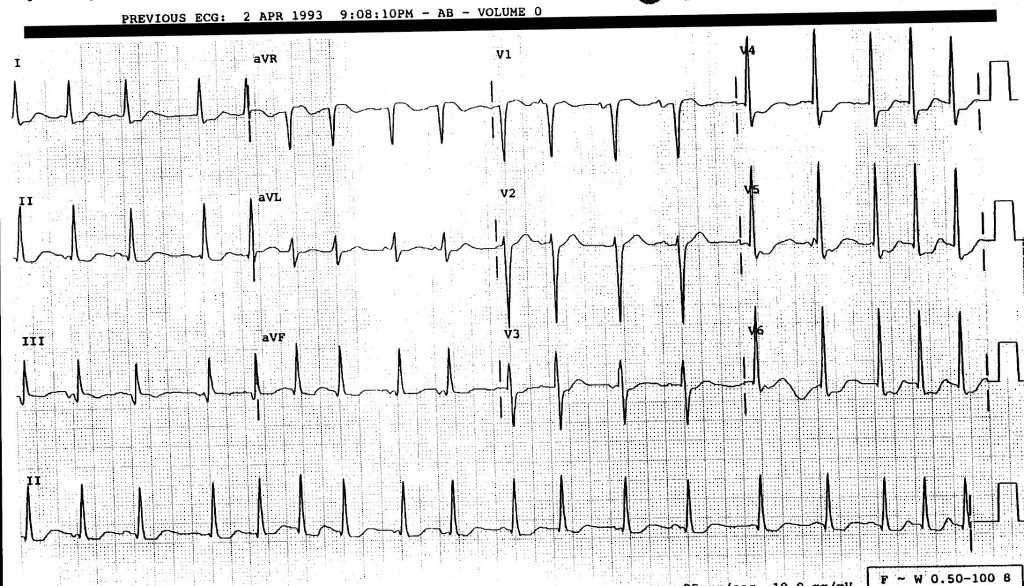 ECG1