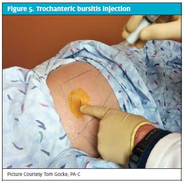 Trochanteric Bursitis - Knee & Sports - Orthobullets