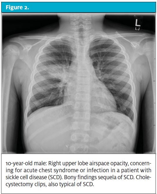 When chest pain is “just” costochondritis