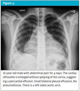 Chest X-ray of 16-year-old with Abdominal Pain