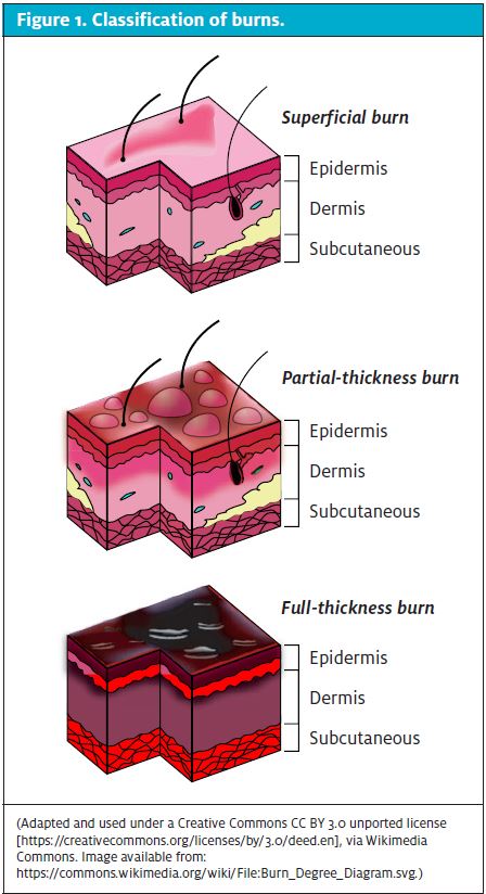 Burns 1, Clinical examples 