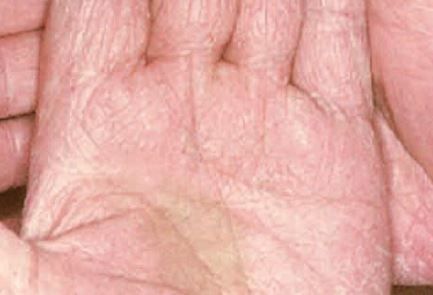 Tinea manuum: Pictures, symptoms, and treatments