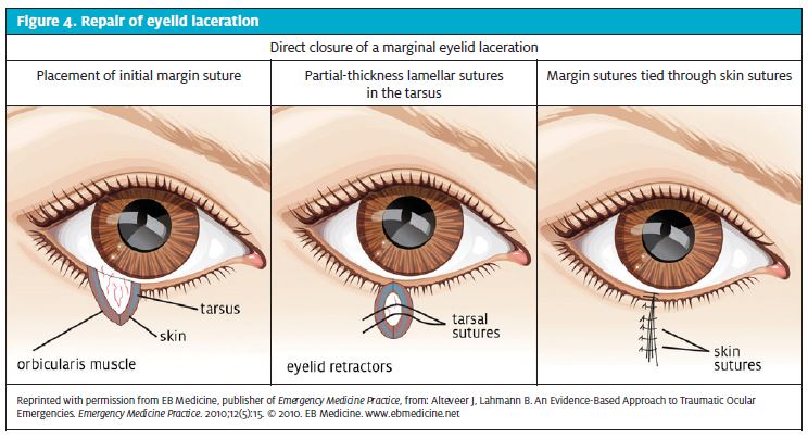 Facial Laceration Repair