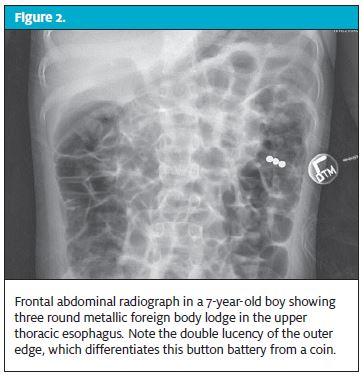 Approach to Ingested Foreign Bodies in Children Journal of