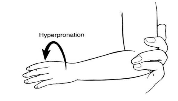 Figure 2. Hyperpronation method. In this method, the examiner supports the child's arm at the elbow and places moderate pressure on the radial head with one finger. The examiner grips the child's distal forearm with the other hand and hyperpronates the forearm. A click may be felt by the finger over the radial head when the subluxation is reduced.