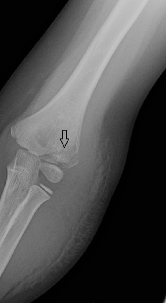 Lateral Humeral Condyle Fracture | Journal of Urgent Care Medicine