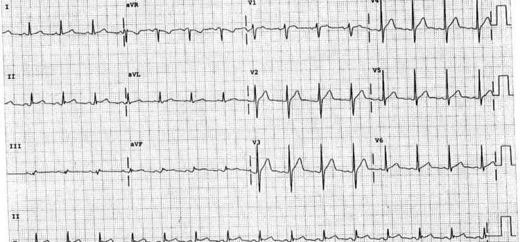 A 37-Year-Old Man with a Two-Day History of Chest Pain